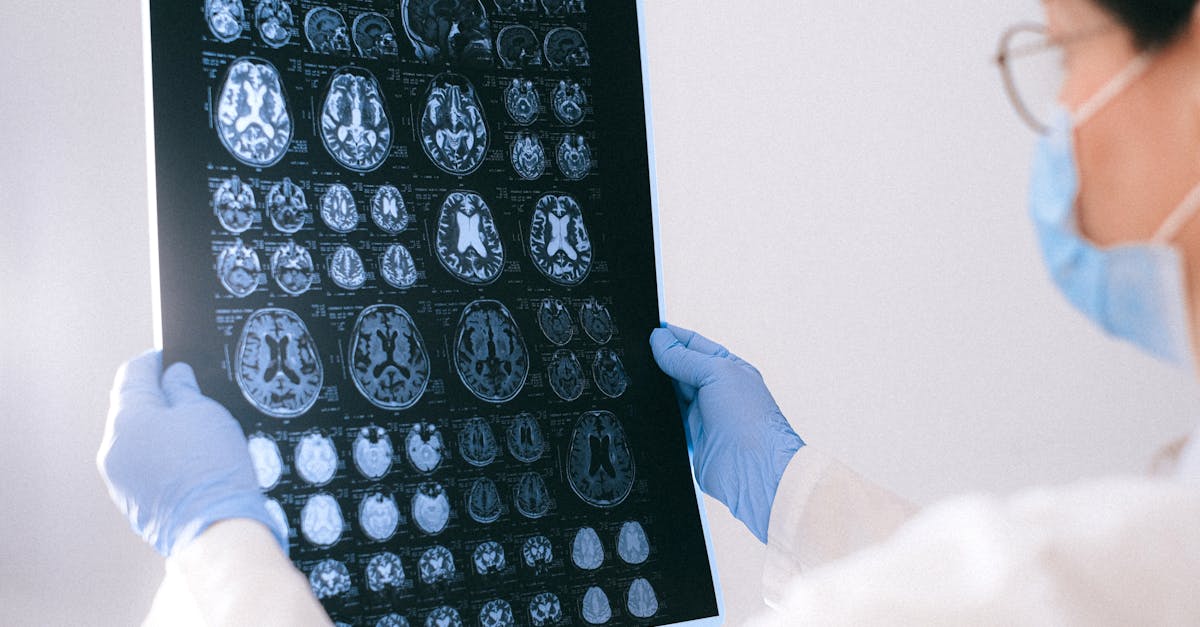 Researcher in white coat analyzing neurons and amyloid brain plaques under a microscope